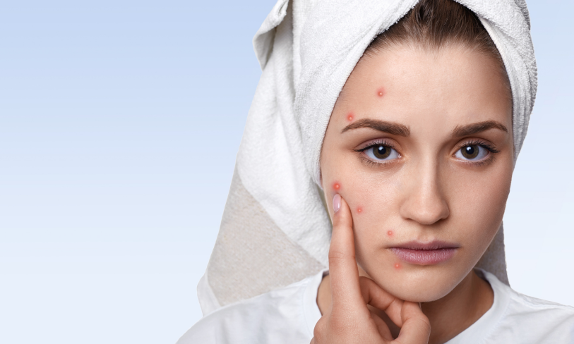 Top 5 Acne Myths Debunked by Skin Health Experts (2)